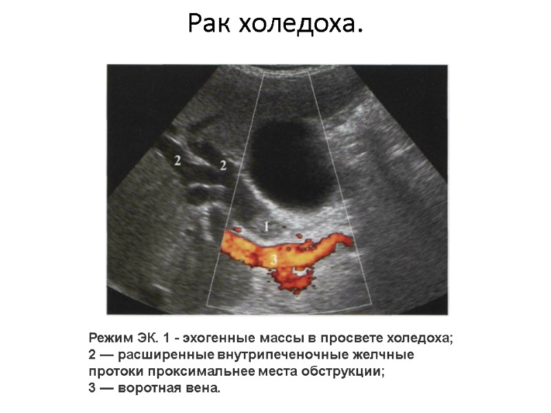 Рак холедоха.  Режим ЭК. 1 - эхогенные массы в просвете холедоха; 2 —